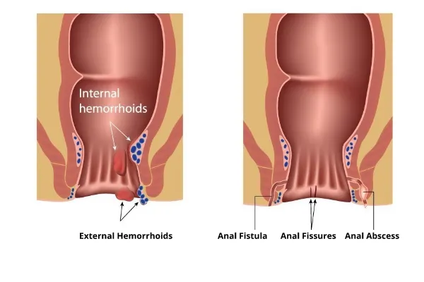 Diagram of internal and external hemorrhoids, anal fistula, fissures and abscess
