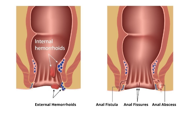 anal_disorders-600