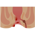 Hemorrhoid illustration